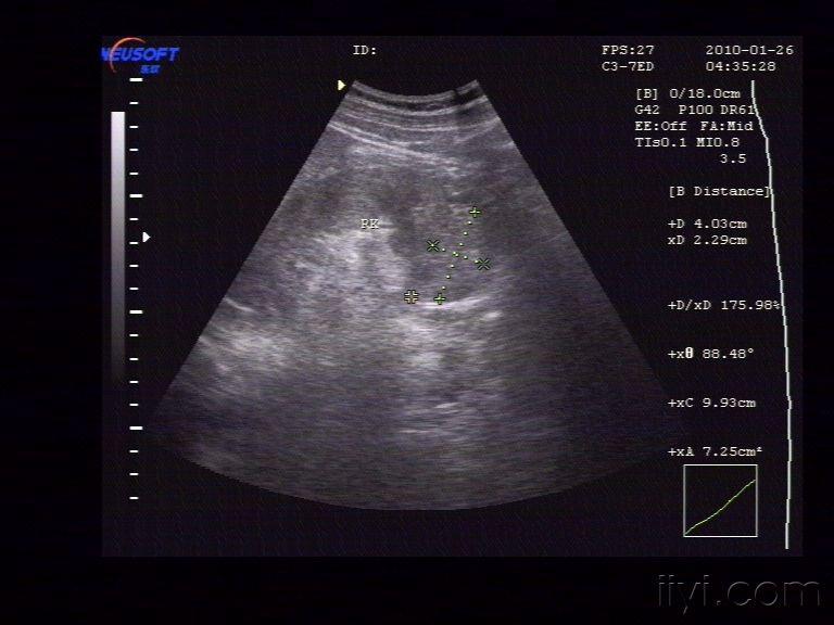 肾脏挫裂伤 - 超声医学讨论版 - 爱爱医医学论坛