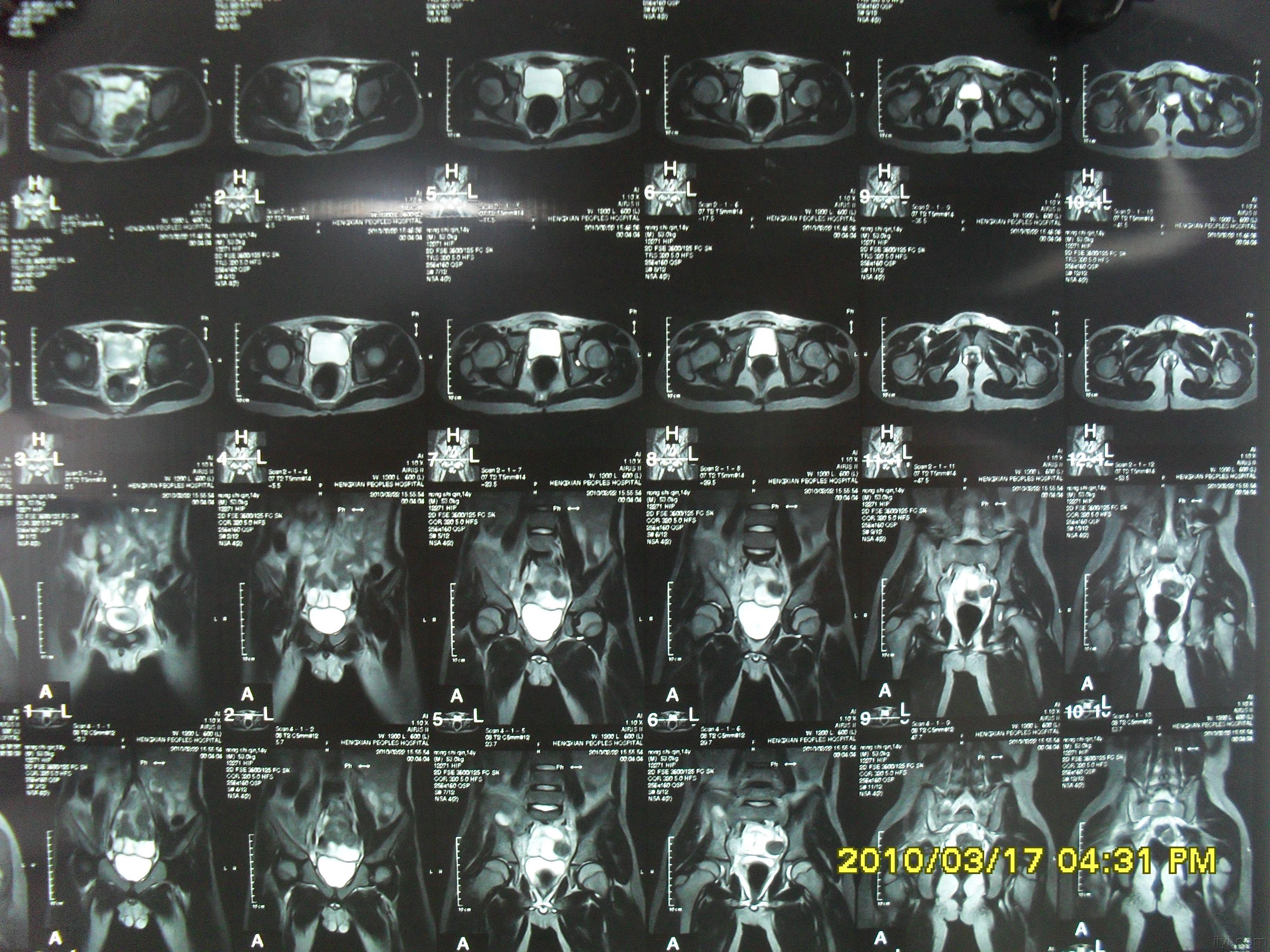 骶髂关节MRI图片