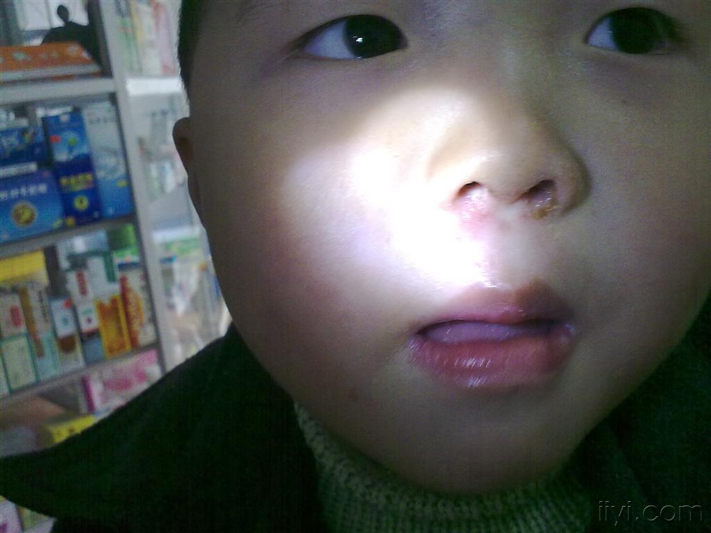 5岁小孩,鼻孔周围经常留脓样,是什么病了,怎么治疗?