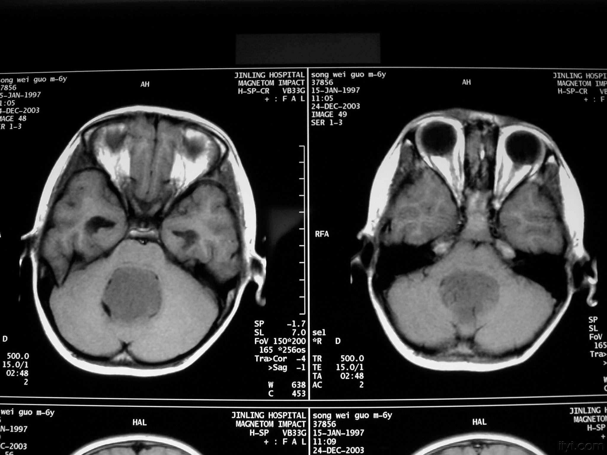 小脑病变ctmri病理结果已公布20100326