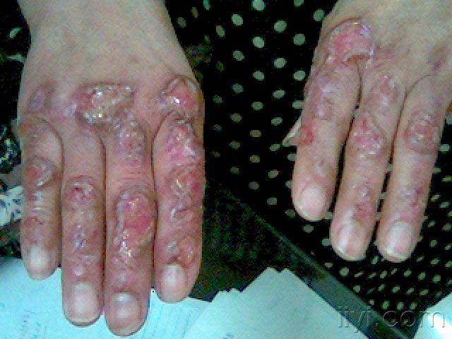 双手背疼痛性溃疡经久不愈照片质量欠佳