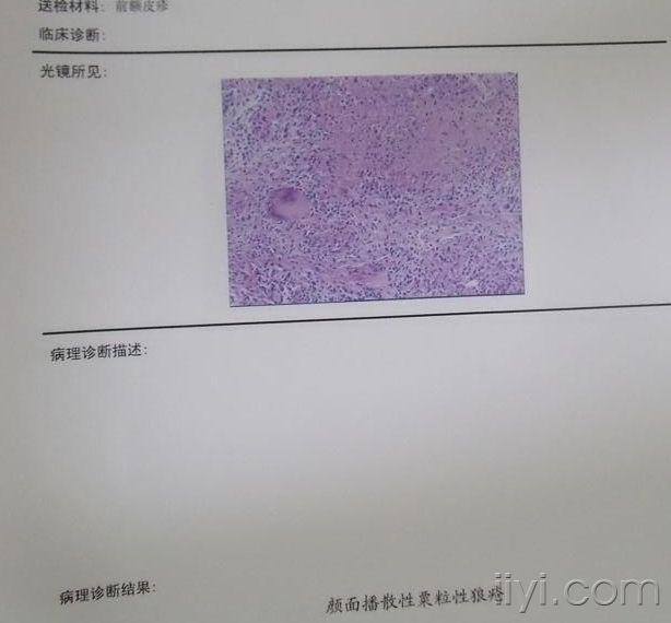 颜面播散性粟粒状狼疮--门诊照片 - 皮肤及性传播疾病讨论版 - 爱爱医