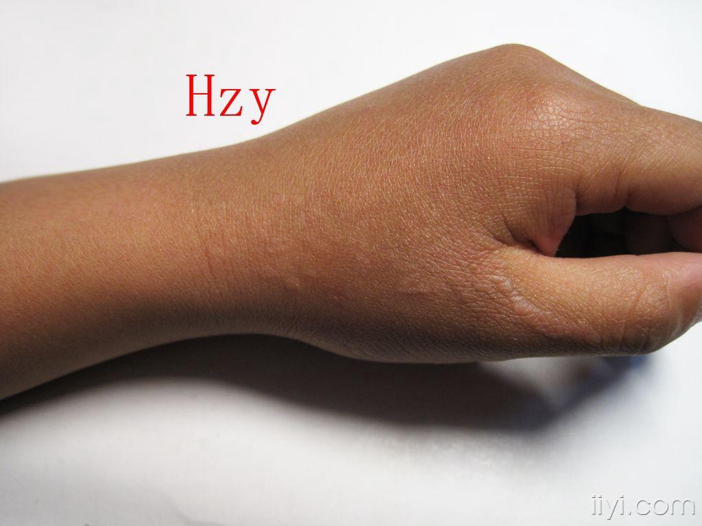 公布答案:线状苔藓 - 皮肤及性传播疾病讨论版 - 爱爱医医学论坛