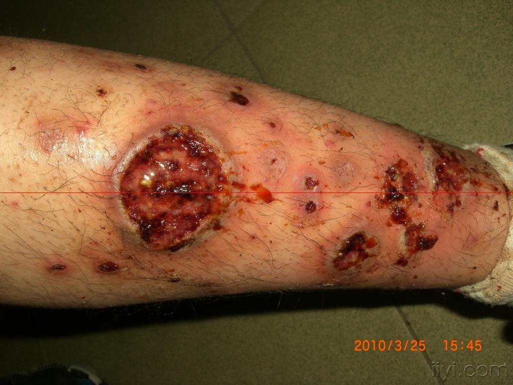 血管炎晚期症状图片图片