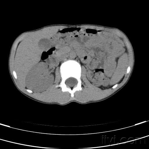 左肾缺如请教脾脏的改变