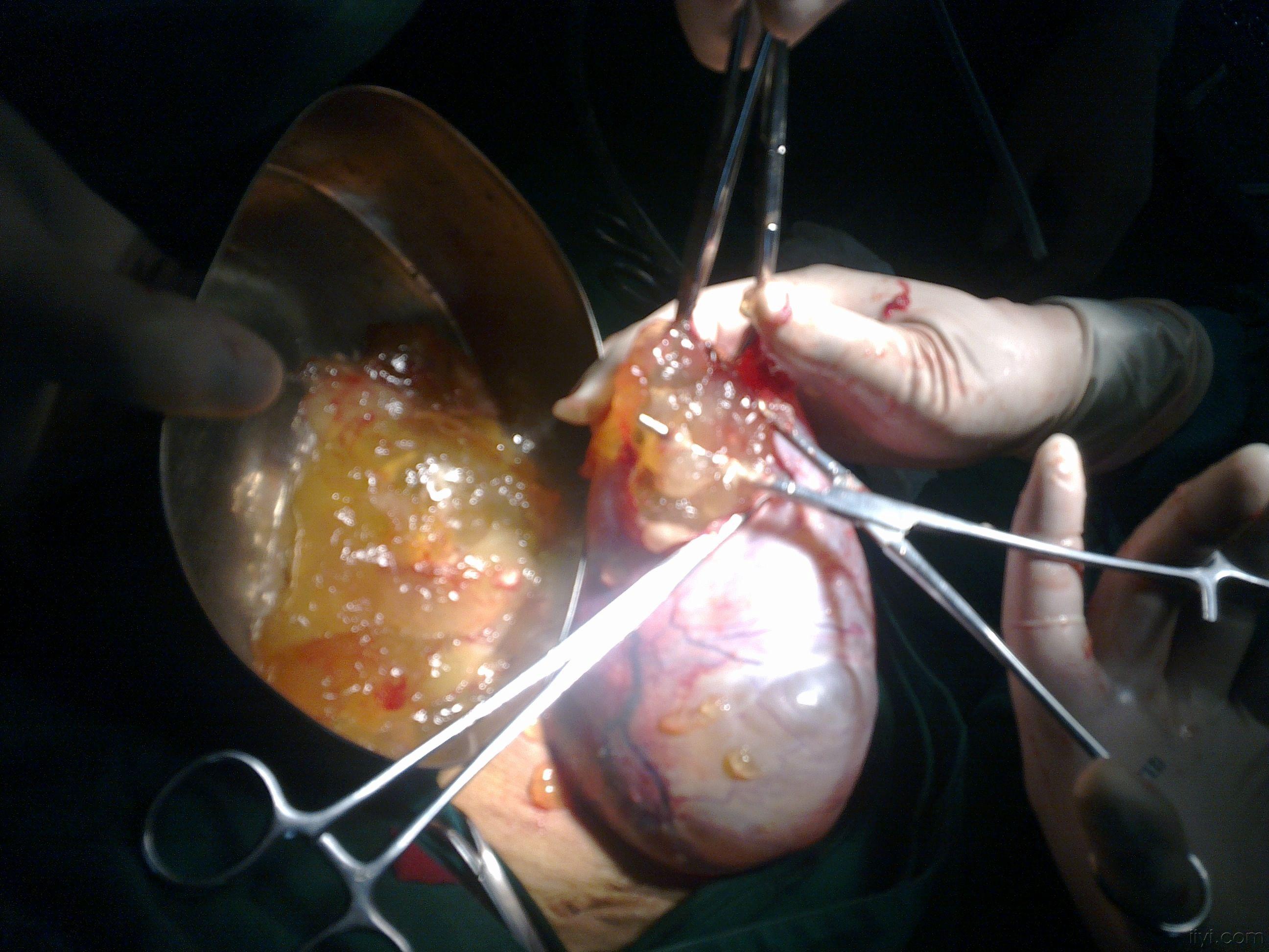 最近主任做的一个双侧卵巢粘液腺瘤手机照的