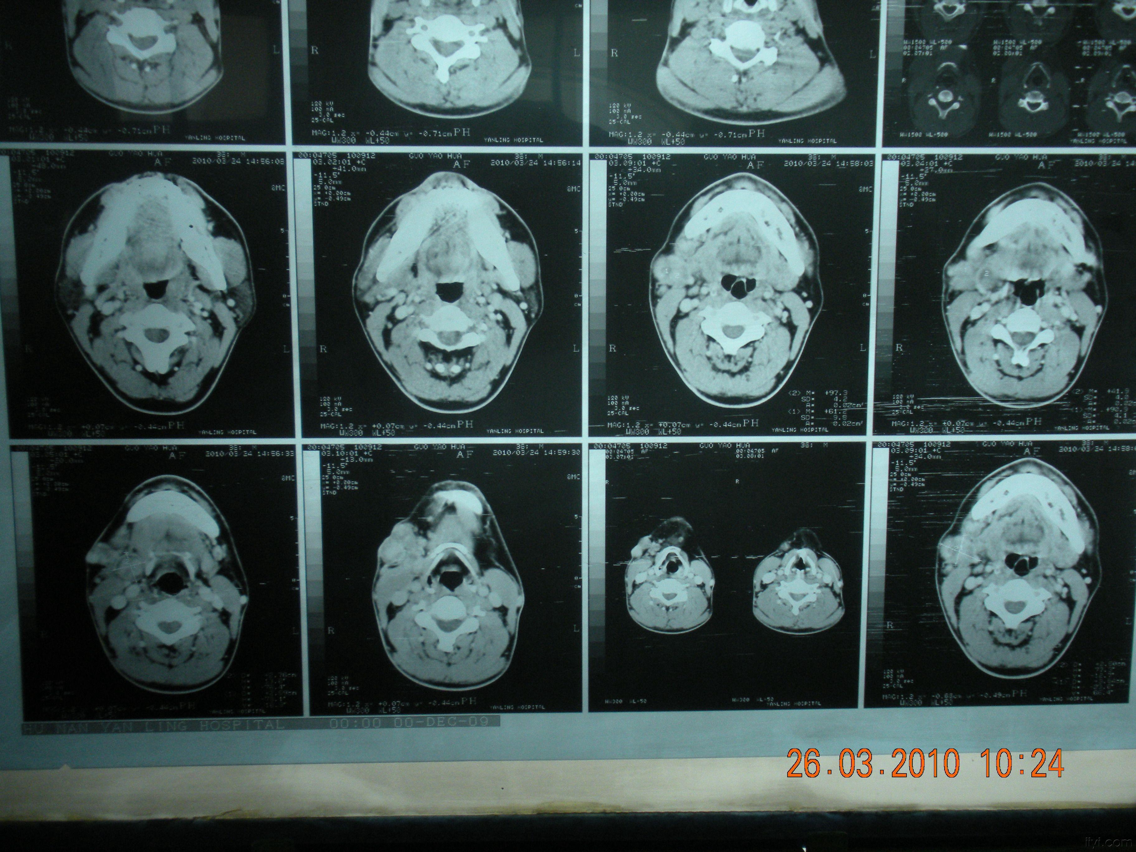 颌下腺 CT图片