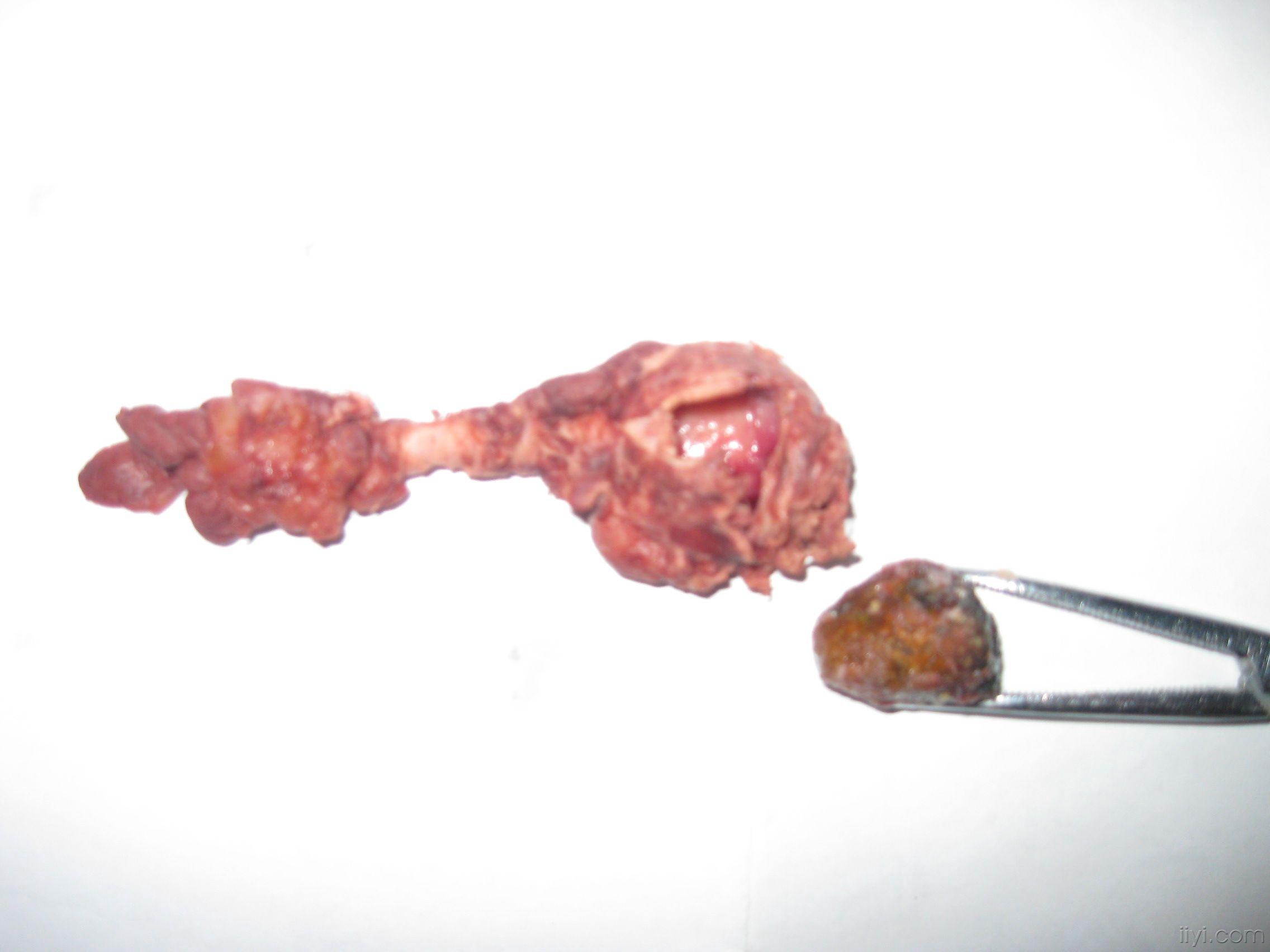 罕见的阑尾粪石附图