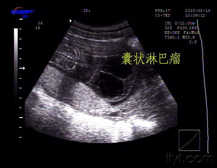 胎儿发育畸形囊状淋巴瘤(11.jpg