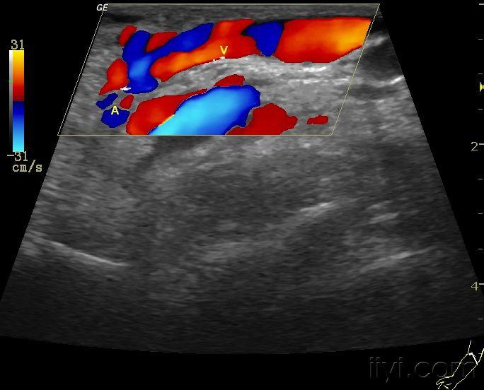 子宫动静脉瘘超声图片