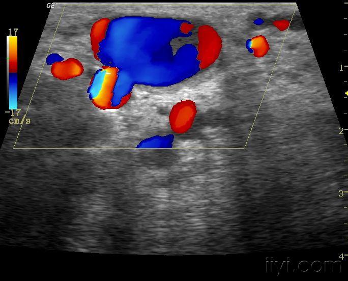动静脉瘘 - 超声医学讨论版 - 爱爱医医学论坛