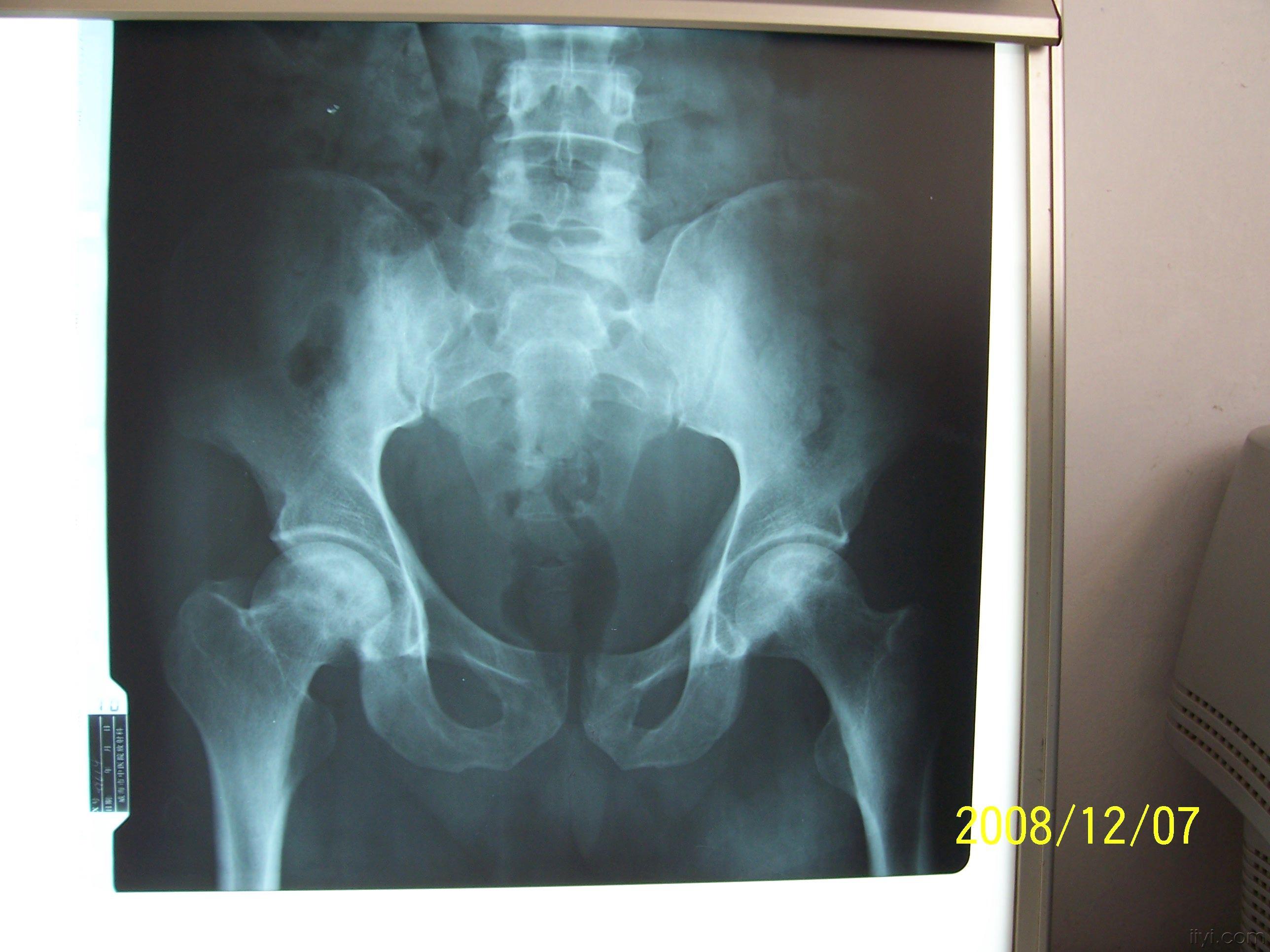 骨梗死的x片,比较少见哦