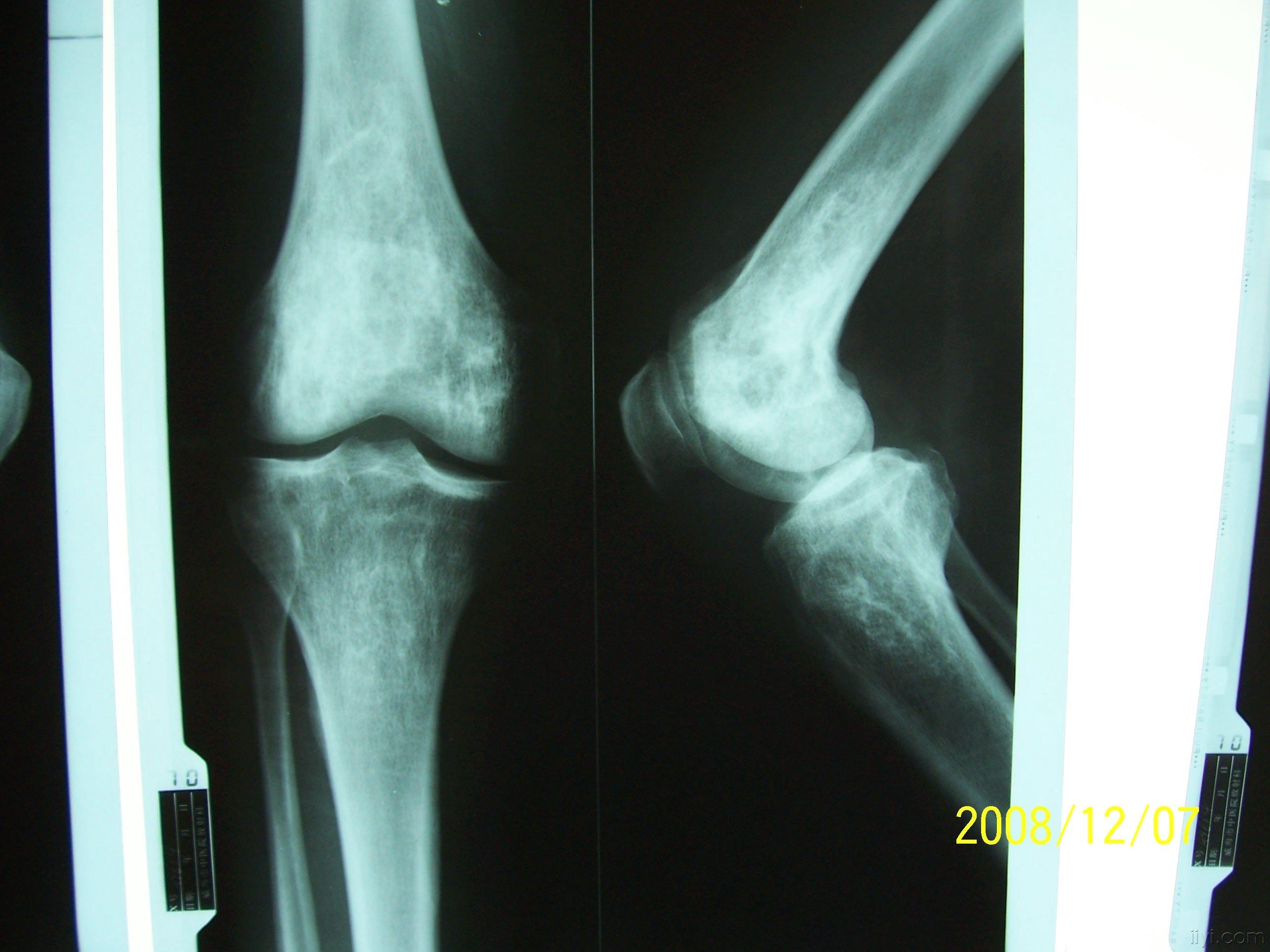 骨梗死的x片,比较少见哦