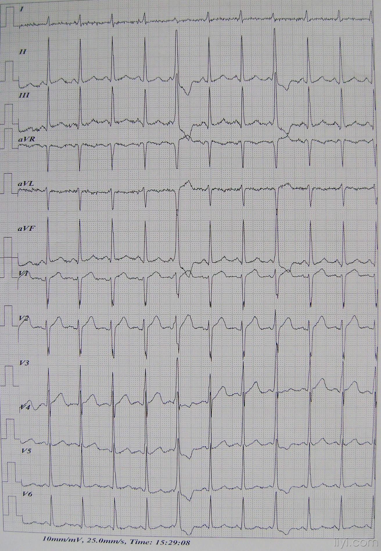動態心電圖中許多異性的室性早搏討論下