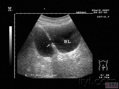 一膀胱憩室片片 - 超声医学讨论版 - 爱爱医医学论坛