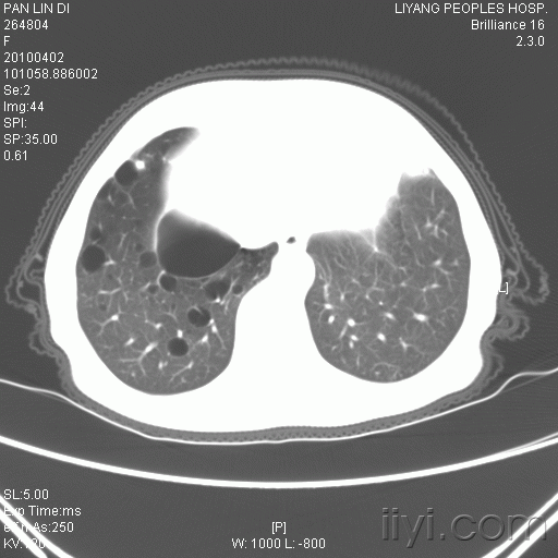 少见的支气管肺囊肿伴感染