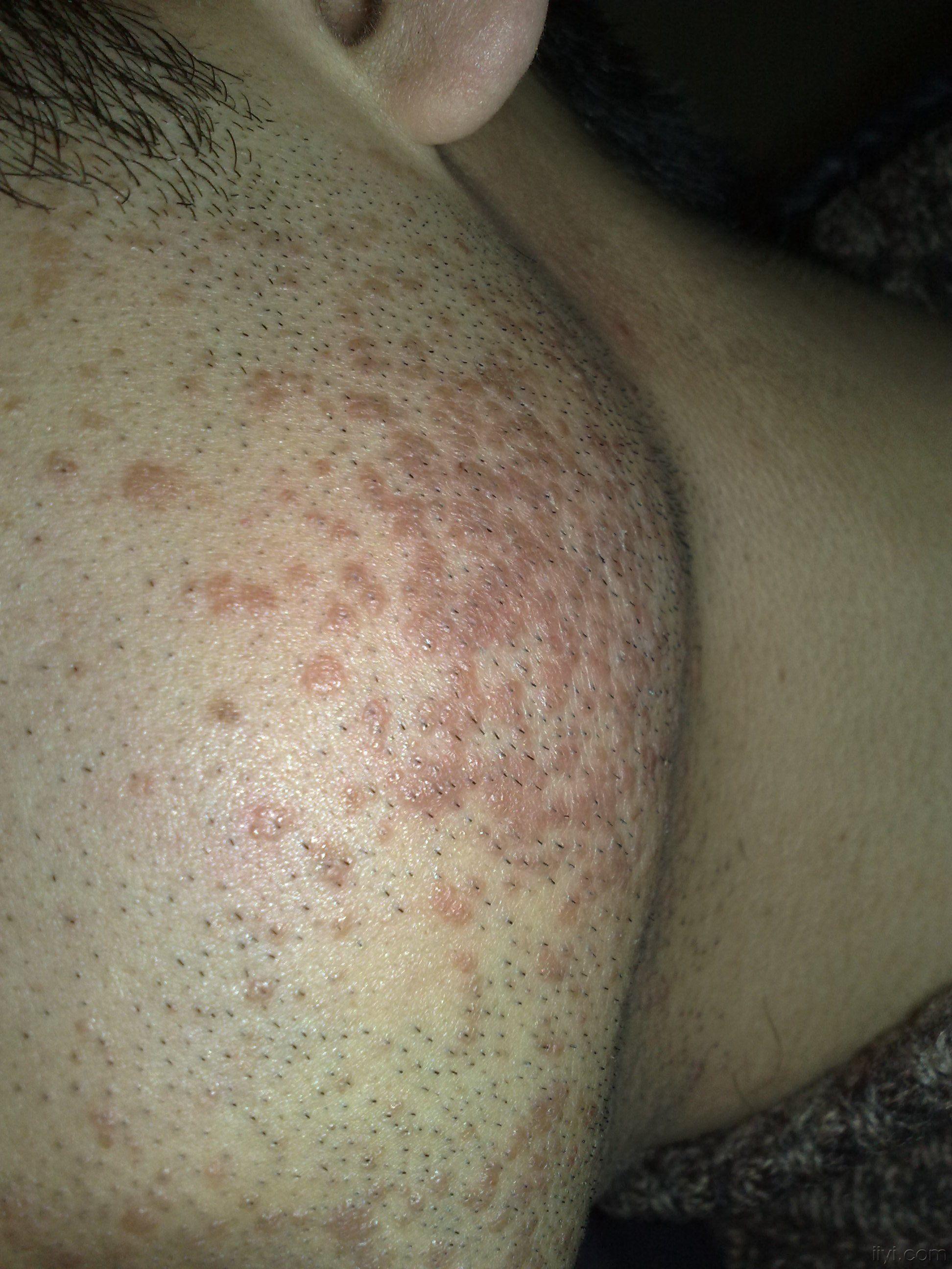 专家看看是什么病怎么样治疗好推荐好方法