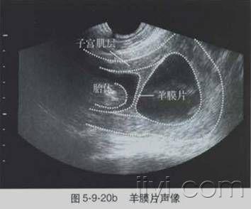 羊膜带综合征超声图片图片