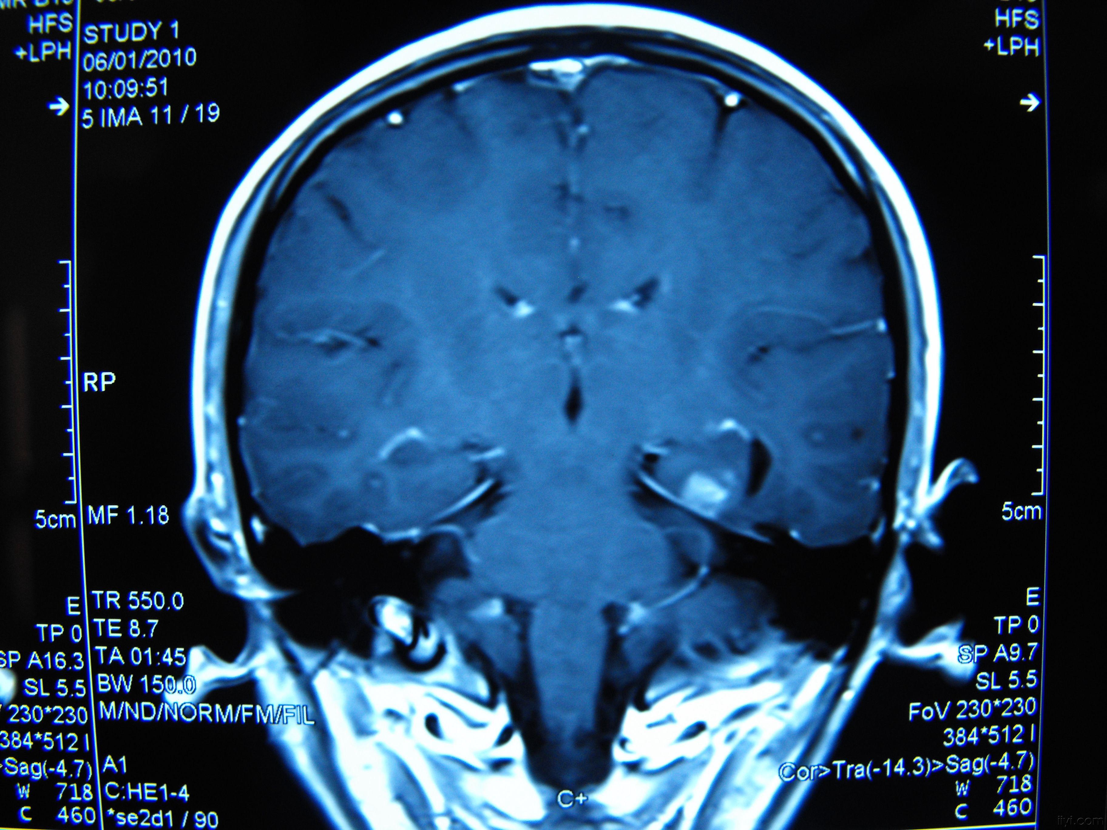 一例海马硬化图片