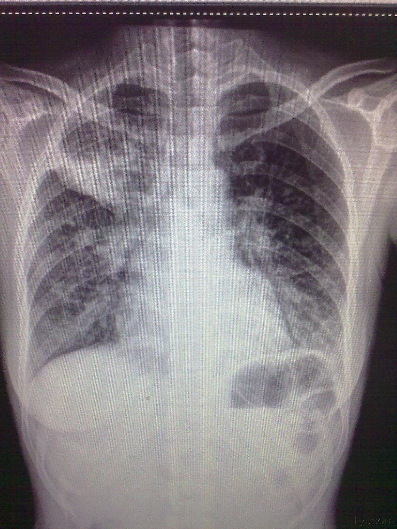 请看哈这张胸片有病理 医学影像学讨论版 爱爱医医学论坛