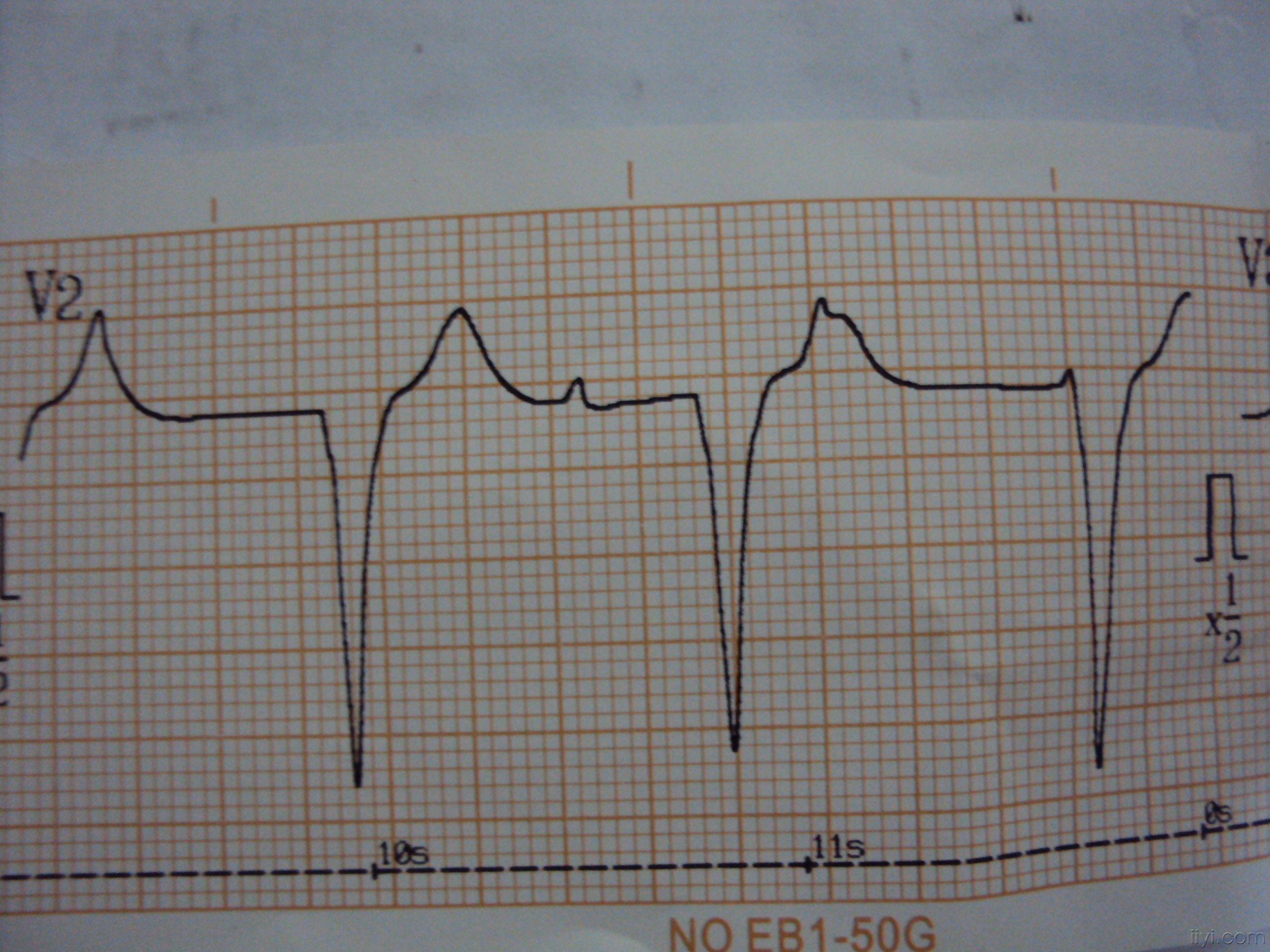 搭脉怎么判断早搏_早搏心电图怎么看图解(2)