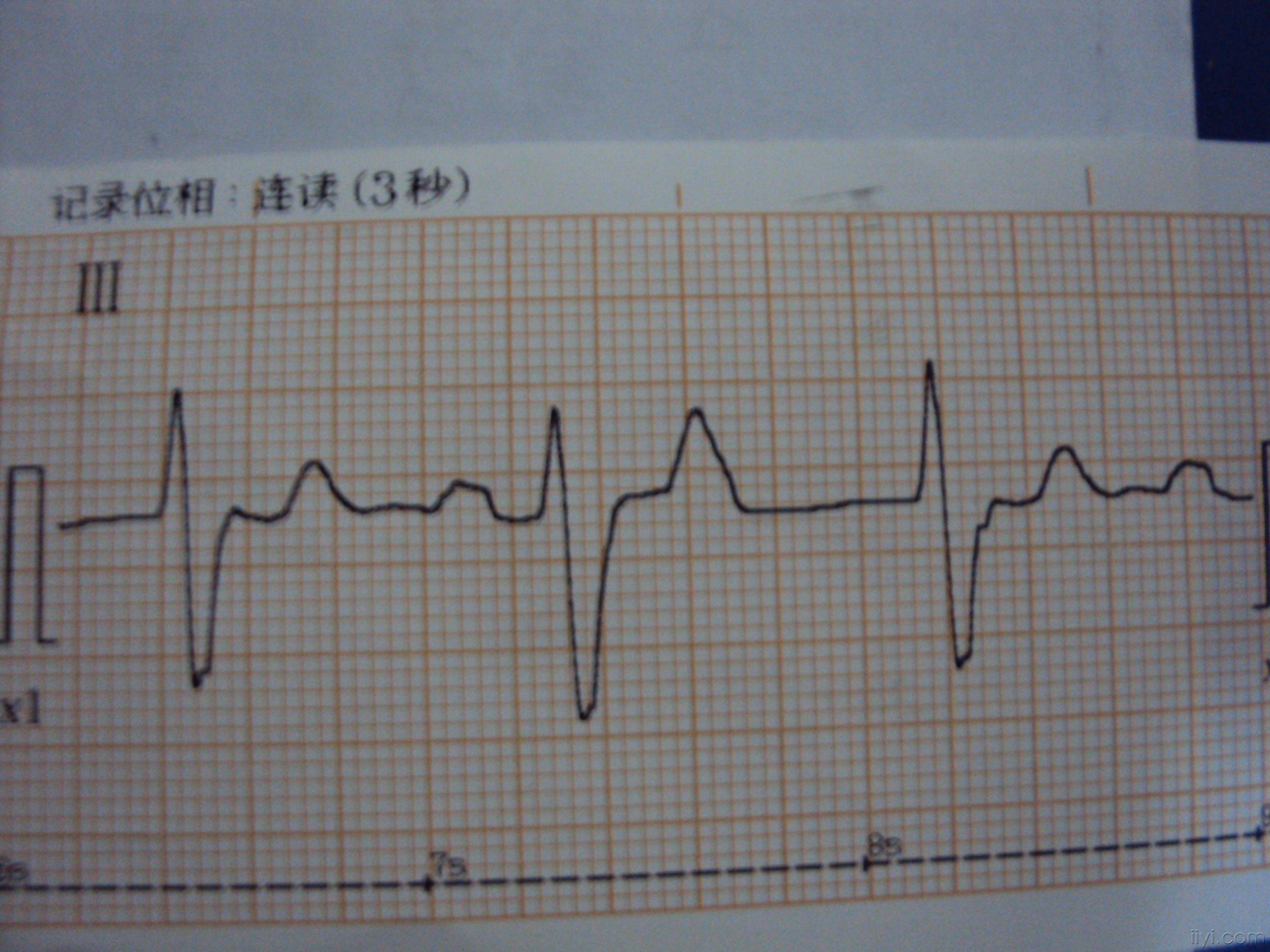 搭脉怎么判断早搏_早搏心电图怎么看图解(2)