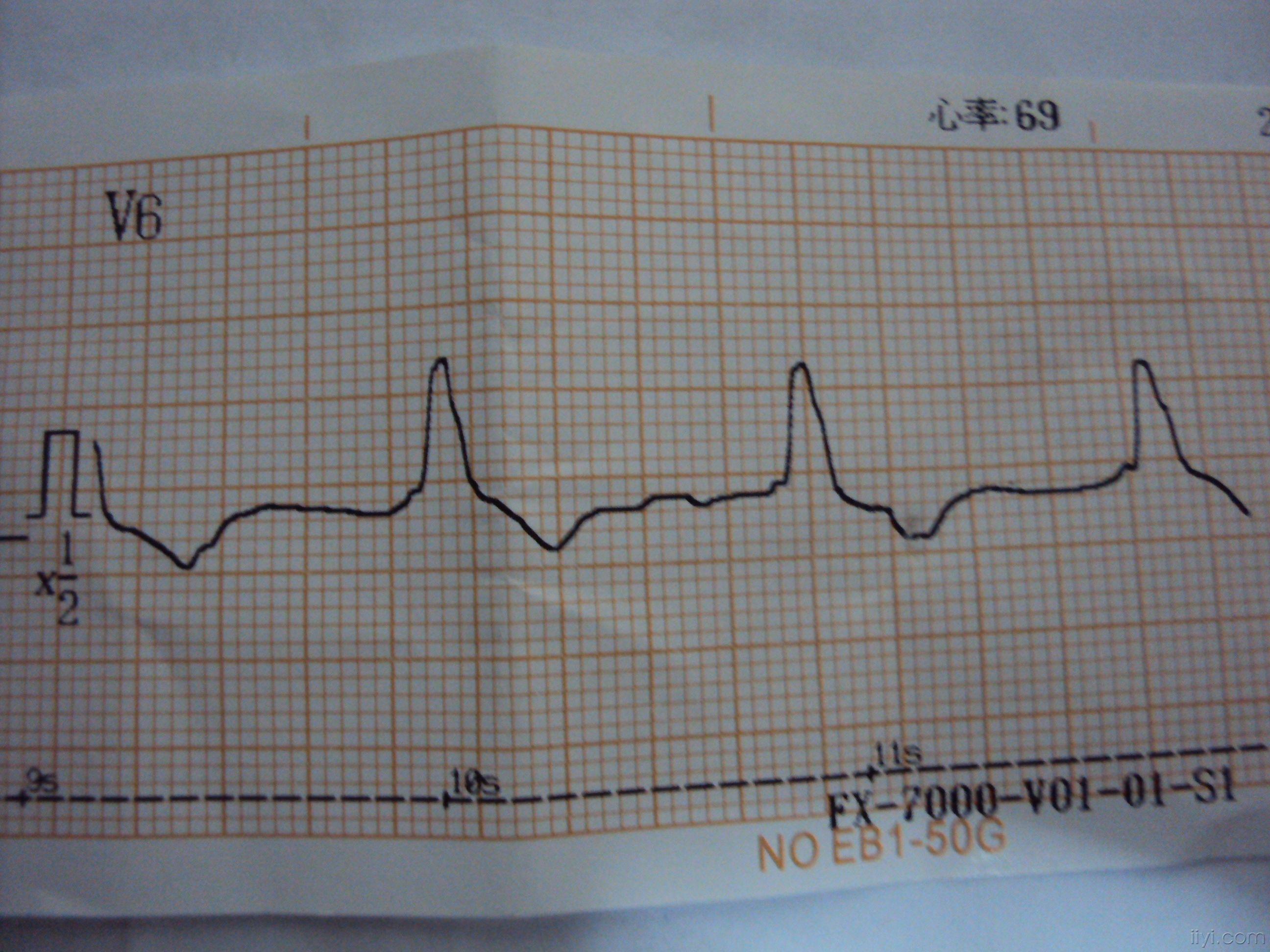 搭脉怎么判断早搏_早搏心电图怎么看图解(2)
