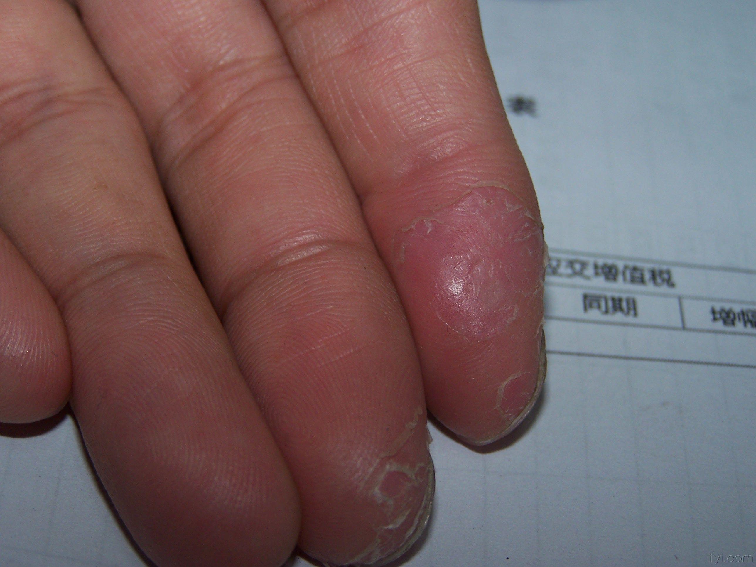 手指局部皮肤变硬、干裂是怎么回事？_百度知道