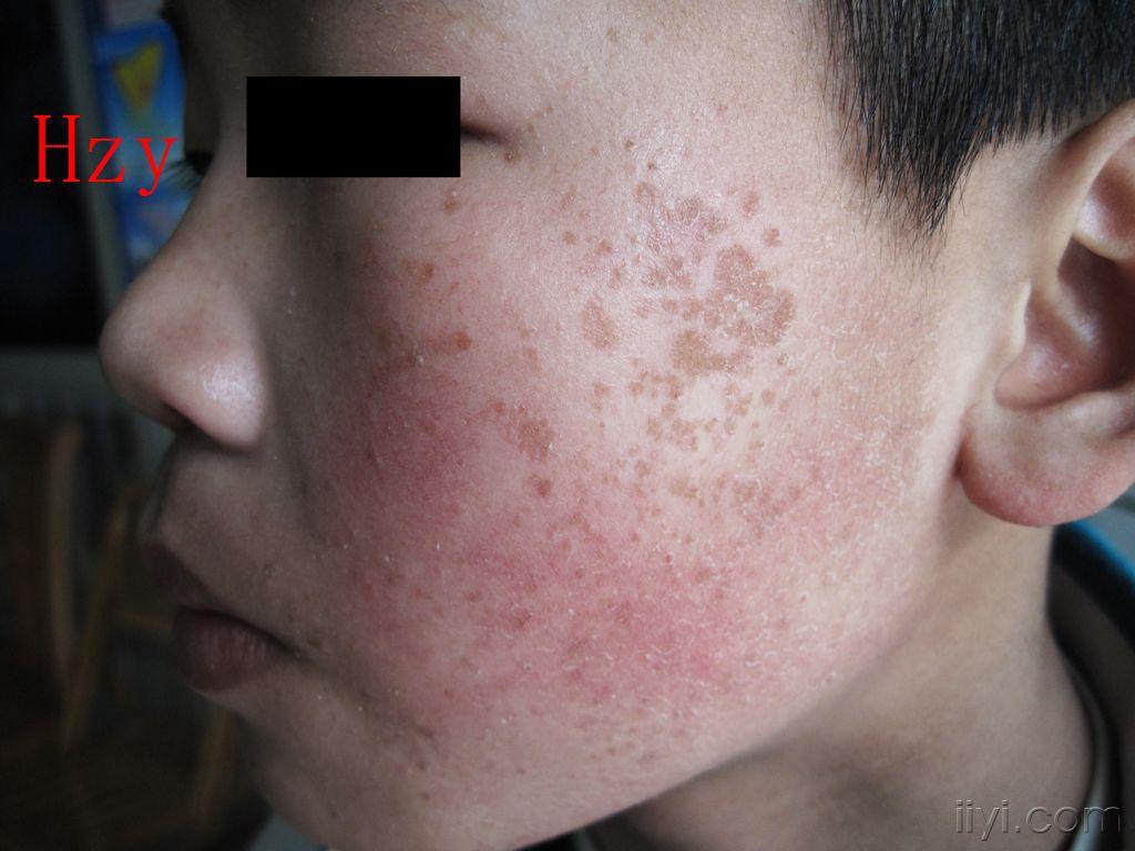 脸部谁能看出他患的是哪两种皮肤病.公布答案:1,扁平疣 .2,鱼鳞病.