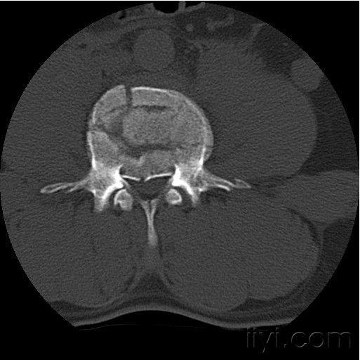 l4椎体爆裂骨折伴l5峡部裂如何手术治疗