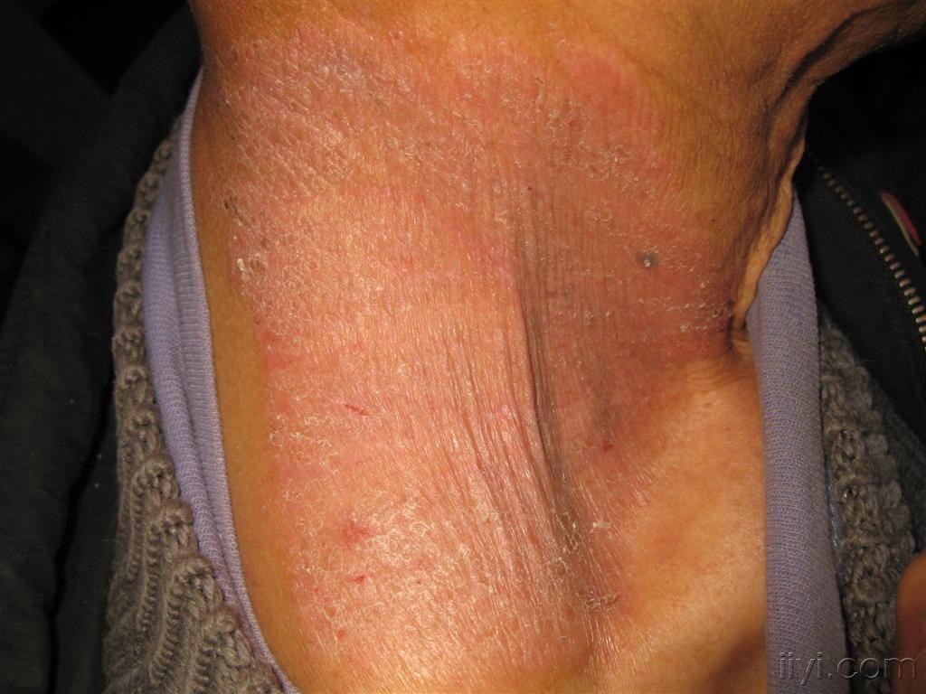 看图识病神经性皮炎