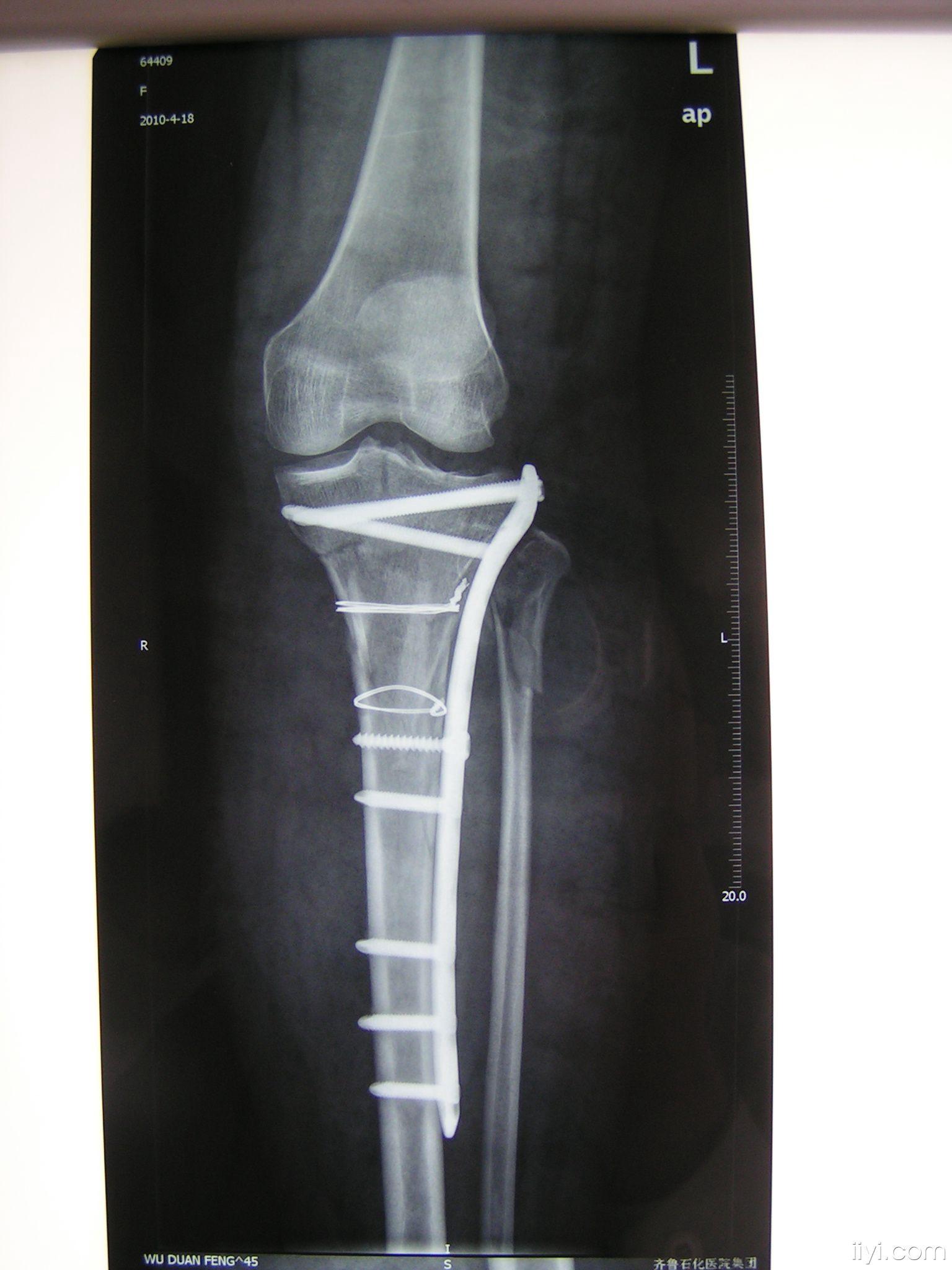 右胫骨平台骨折图片图片