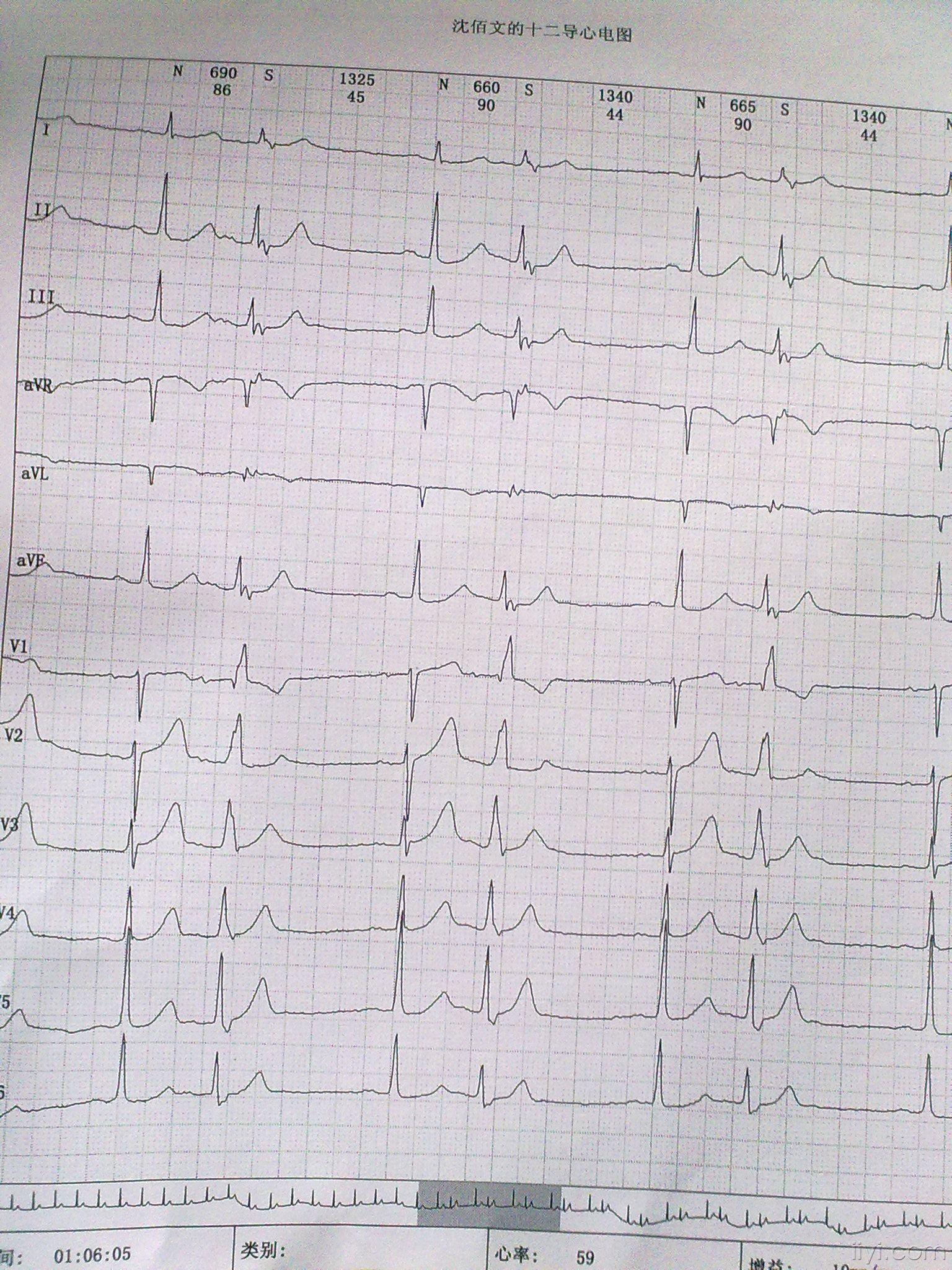 房早二联律心电图表现图片