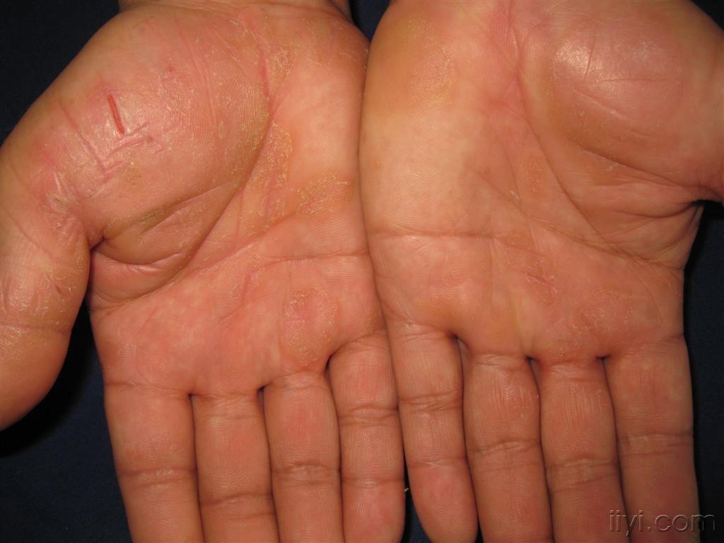 手足湿疹症状图片图片