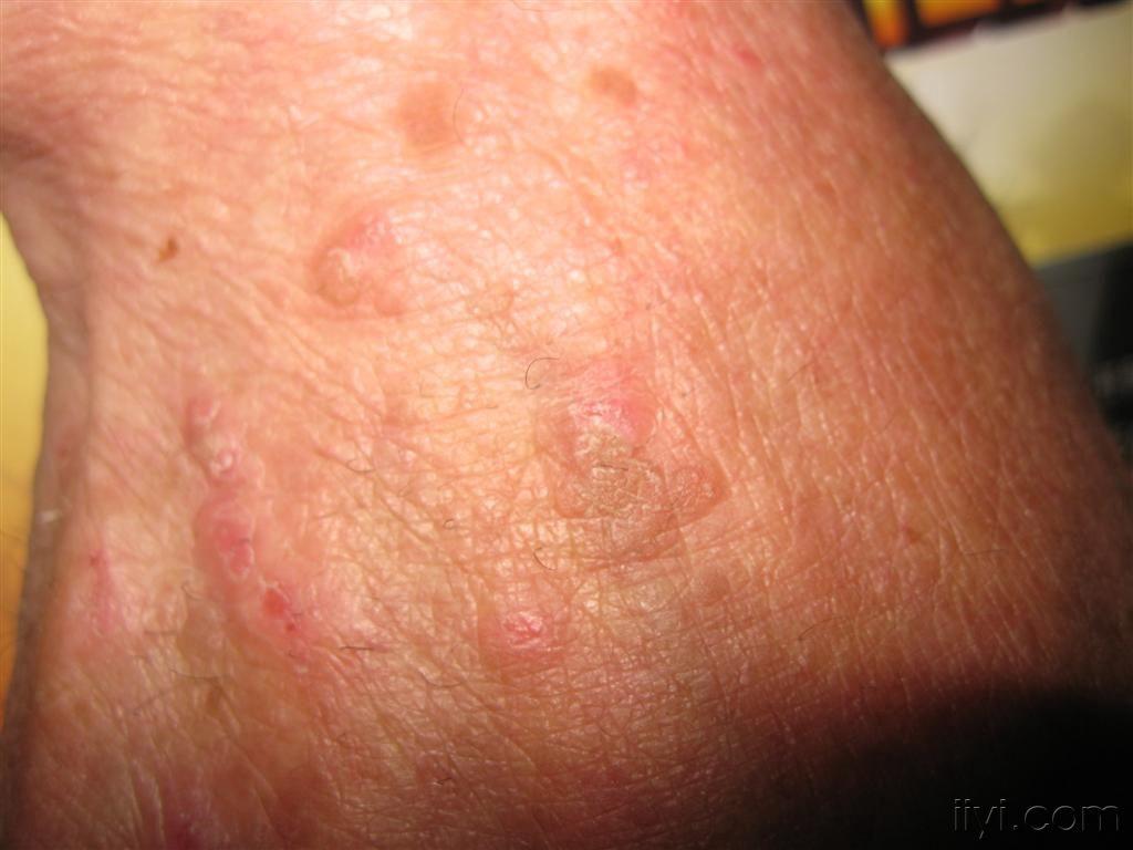 基层的常见病 - 皮肤及性传播疾病讨论版 - 爱爱医医学论坛