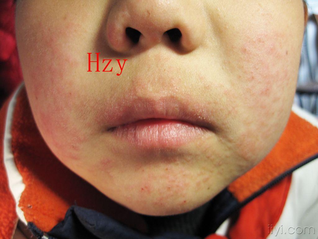 近来小儿脸部患这种病的很多公布答案芒果皮炎