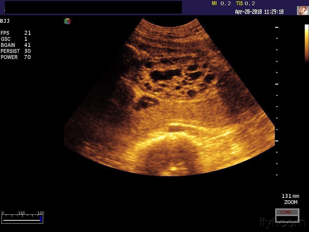 胎左侧多囊肾右肾积水