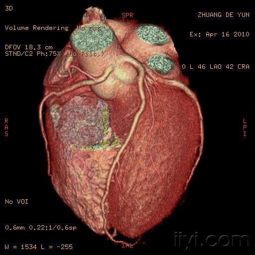 冠状动脉cta及变异大家分享