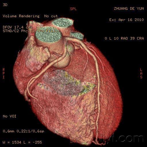 冠状动脉窦瘤图片