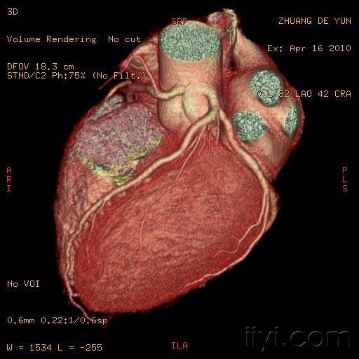 冠狀動脈cta及變異大家分享