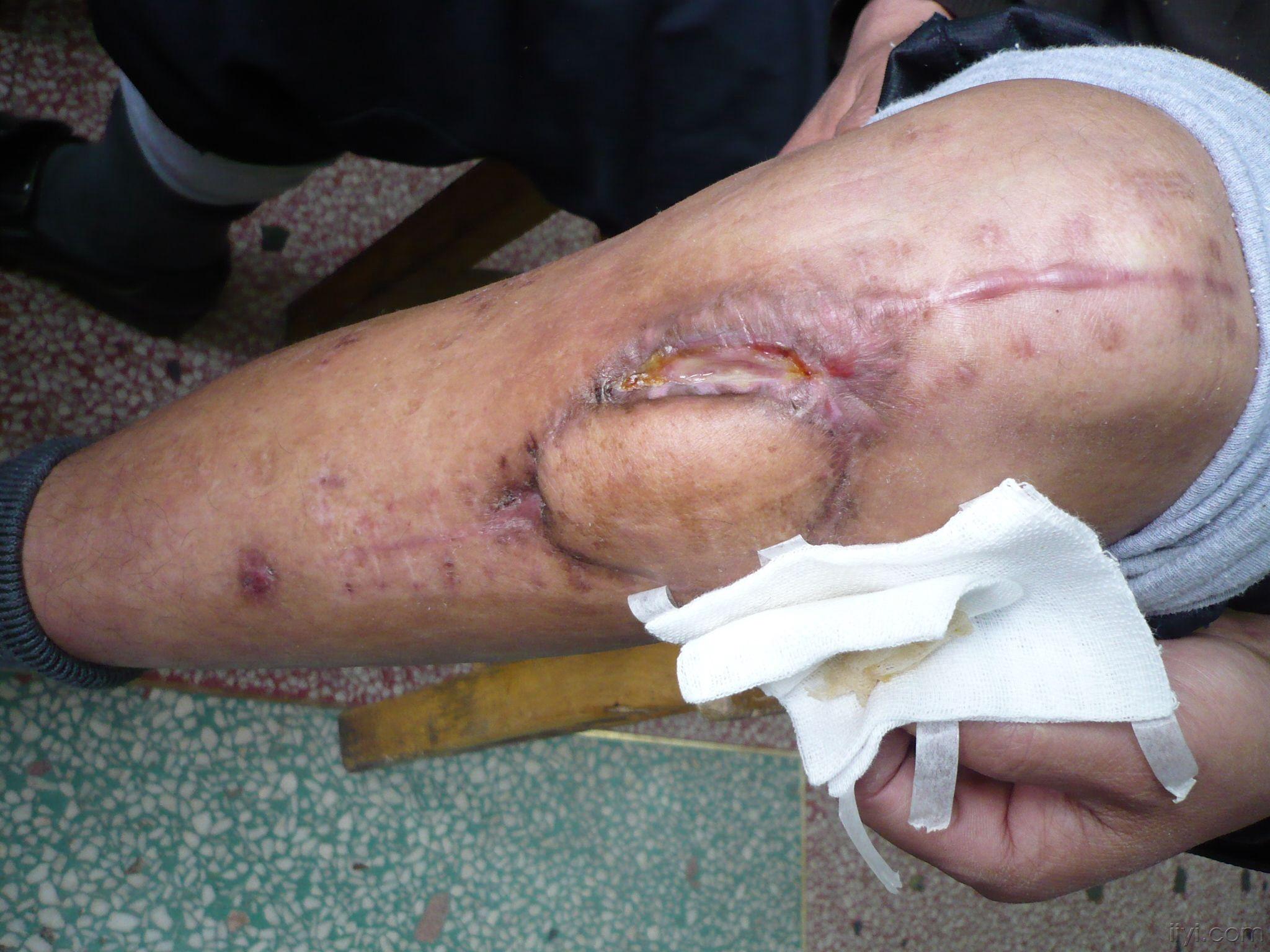 胫骨近端骨折术后钢板外露,请设计一皮瓣