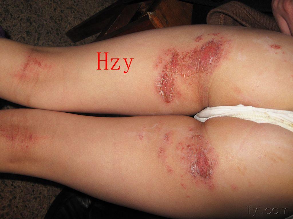 姑娘臀部的皮肤病公布答案湿疹
