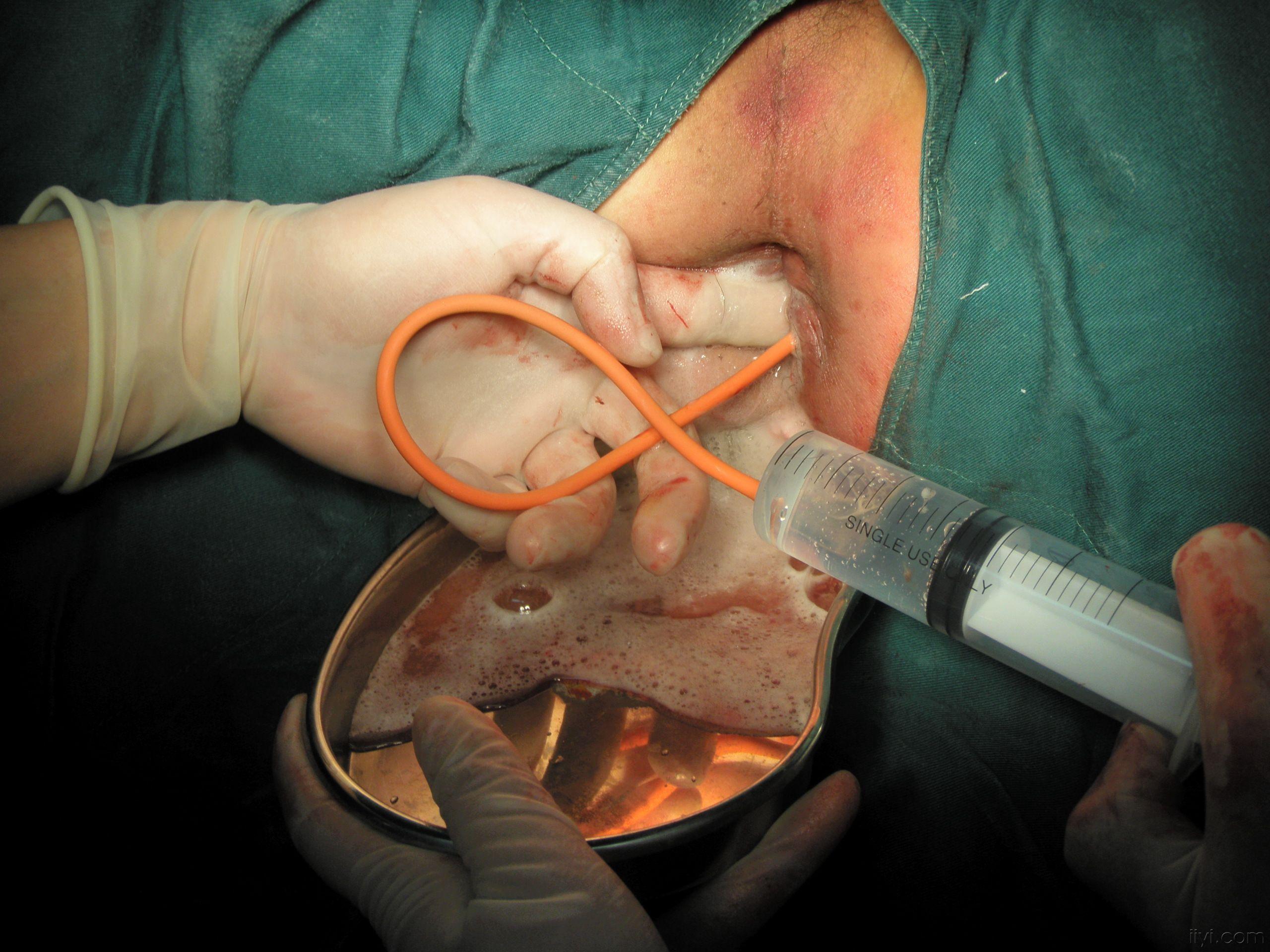 肛周脓肿切开引流手术图片分享