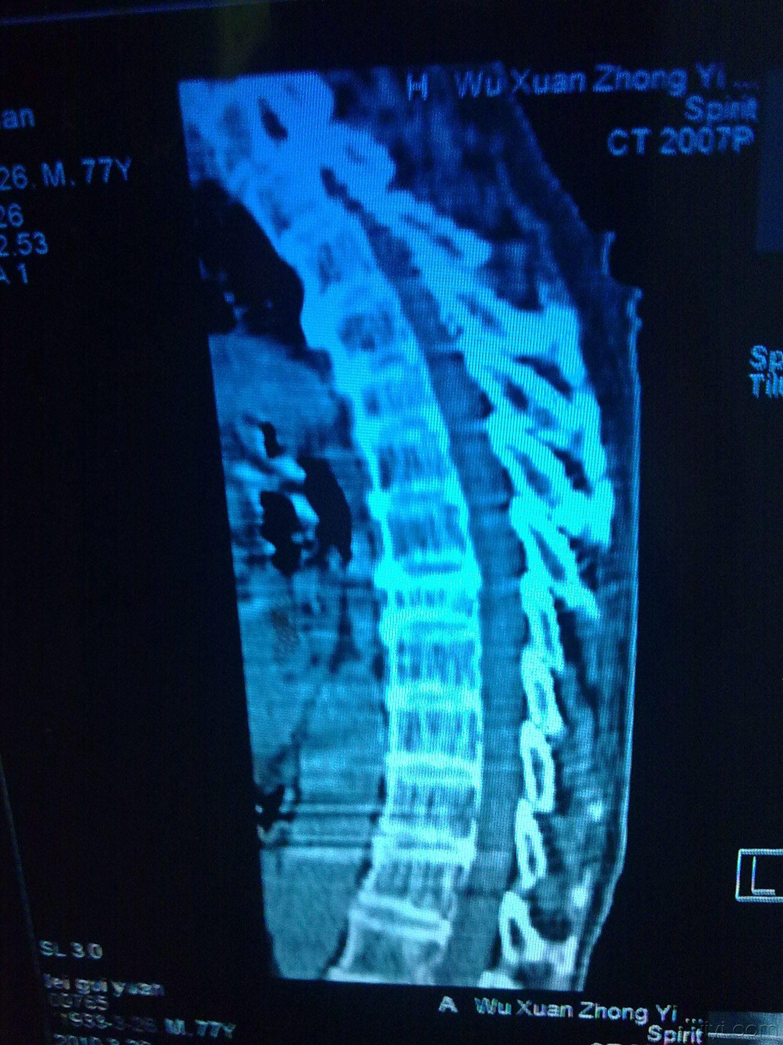 原t9胸椎压缩性骨折?求助贴相关影像检查 请前辈们指点