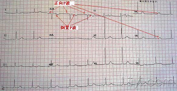 上面的图看不到标准导联,其它导联符合窦性心律的心电图p波特征