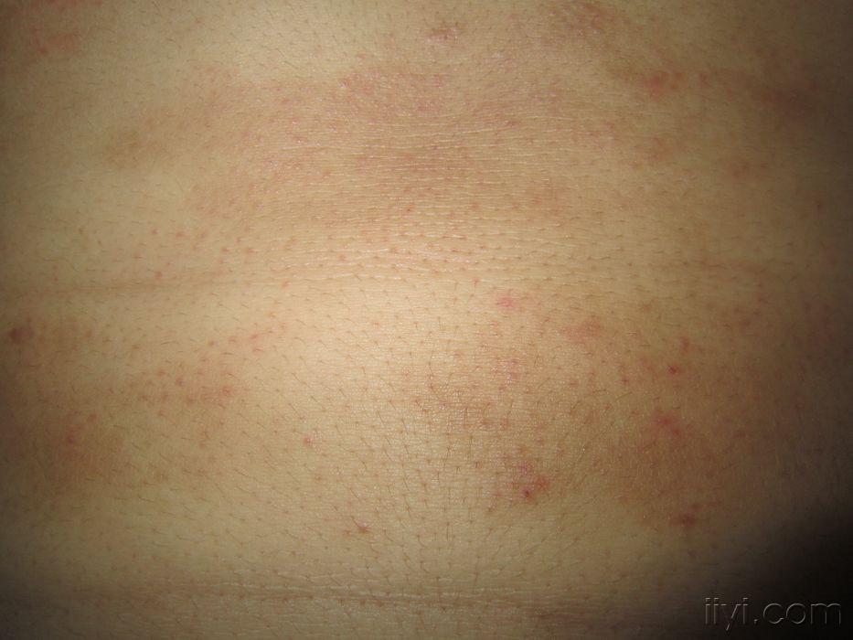罕见一例皮肤斑丘疹