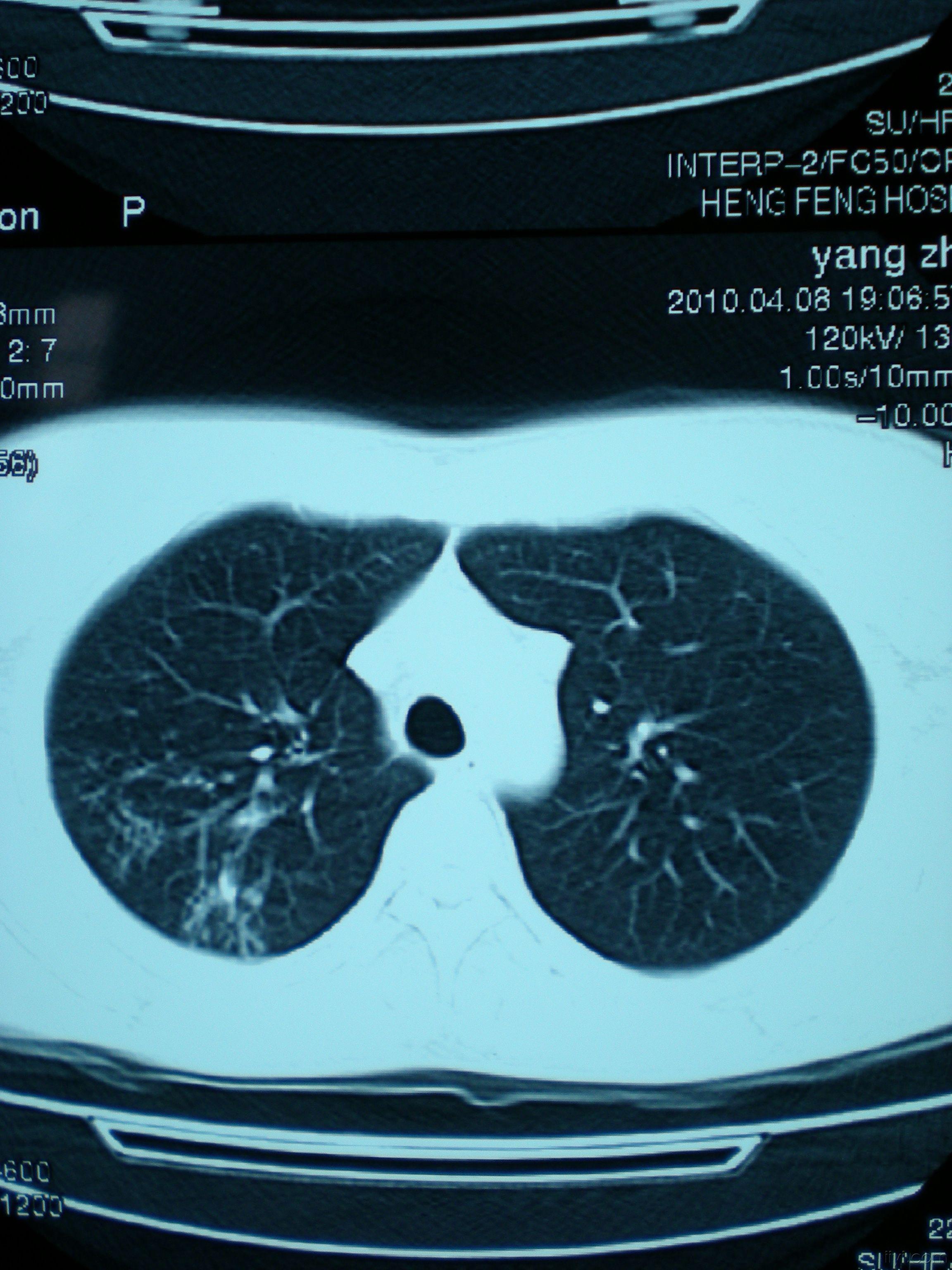 壹生资讯-肺部感染影像诊断宝典|急性血行播散性肺结核