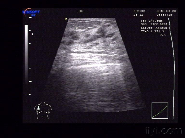 乳腺小叶增生 - 超声医学讨论版 - 爱爱医医学论坛