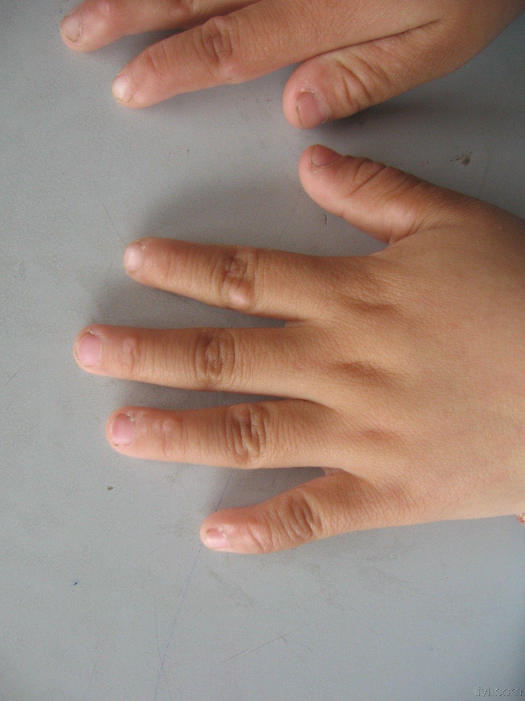 手指脂肪垫图片
