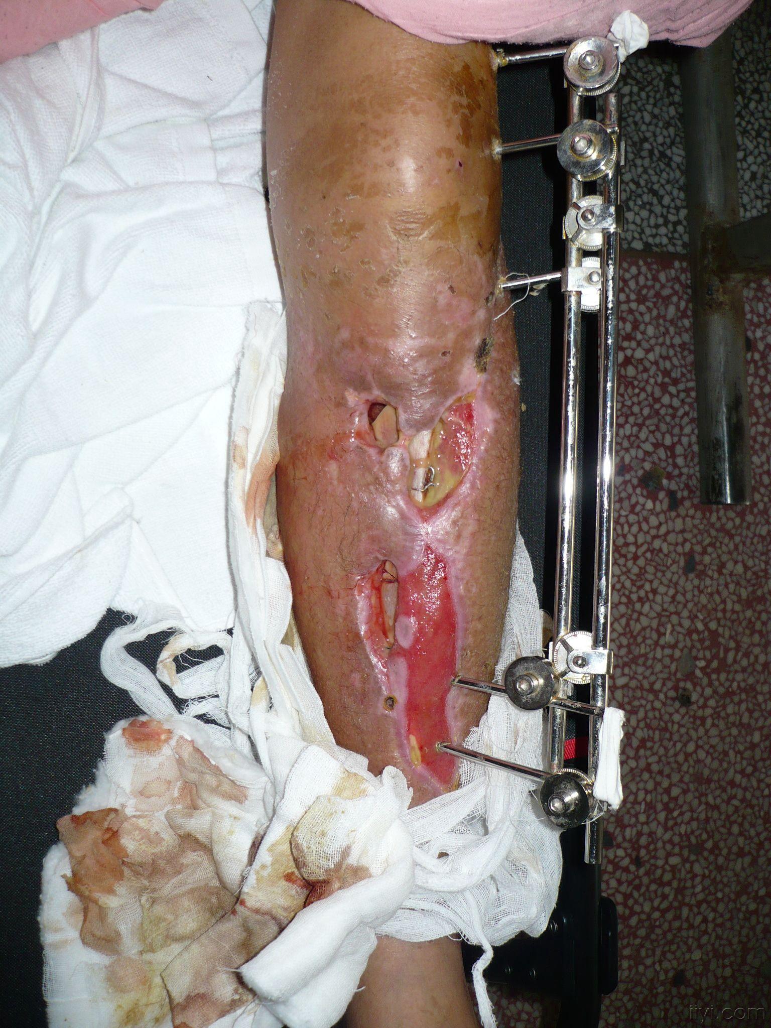 开放性左胫腓骨粉折术后感染并骨髓炎,下一步治疗方案?